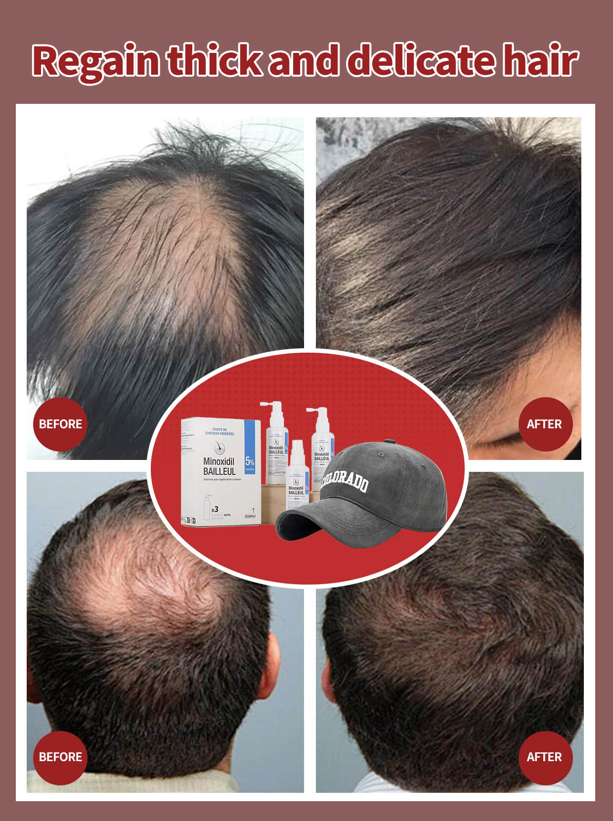 Wearing an extra hat can make minoxidil more effective? – Ziree