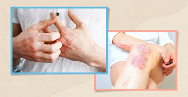 Psoriasis is cured, how to remove the pigmentation left ?