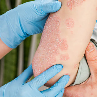 What is psoriasis?