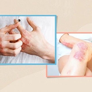 Psoriasis is cured, how to remove the pigmentation left ? - Ziree