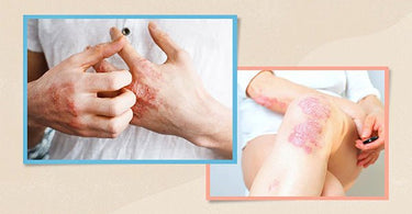 Psoriasis is cured, how to remove the pigmentation left ? - Ziree