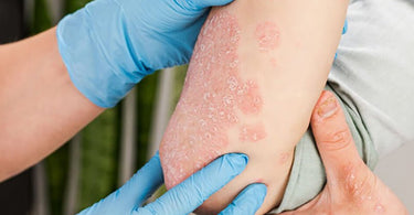 What is psoriasis? - Ziree