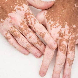 What is vitiligo? - Ziree