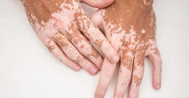 What is vitiligo? - Ziree